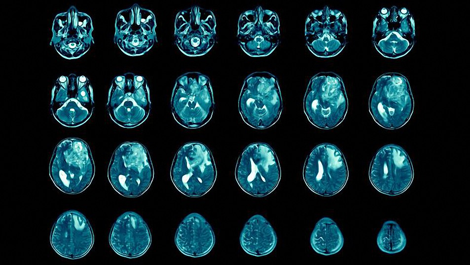 Más de 100 exalumnos de una escuela secundaria diagnosticados con un raro cáncer cerebral mortal: ¿la culpa es de una planta de uranio cercana?