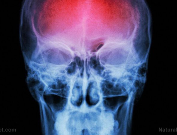X-Ray-Skull-Stroke-Cerebrovascular-Accident