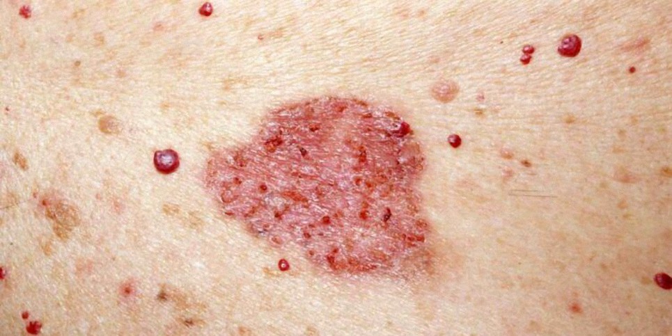 La sorprendente causa del Melanoma (No, no es demasiado sol)