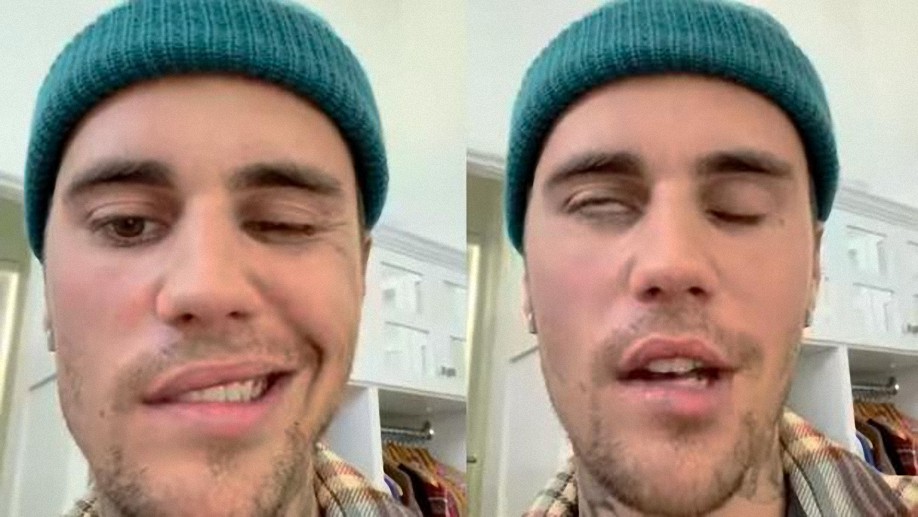 El rostro de Justin Bieber paralizado con el síndrome de Ramsay Hunt, una conocida reacción adversa de las vacunas contra el Covid