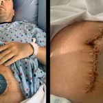 Las fotos muestran una horrible lesión por la vacuna Covid: el hombre pierde 6 pies de intestino delgado debido a un coágulo de sangre