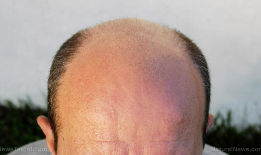 Estudio: comer alimentos ricos en hierro y proteínas ayuda a prevenir la caída del cabello en los hombres