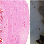 Nuevo estudio informa ‘prueba irrefutable’ de pinchazos de ARNm Covid que causan daño vascular y de órganos