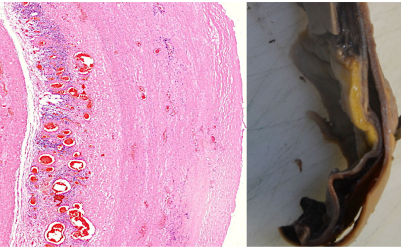 Nuevo estudio informa ‘prueba irrefutable’ de pinchazos de ARNm Covid que causan daño vascular y de órganos