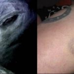 Implantes extraterrestres: ¿Prueba definitiva de las abducciones?