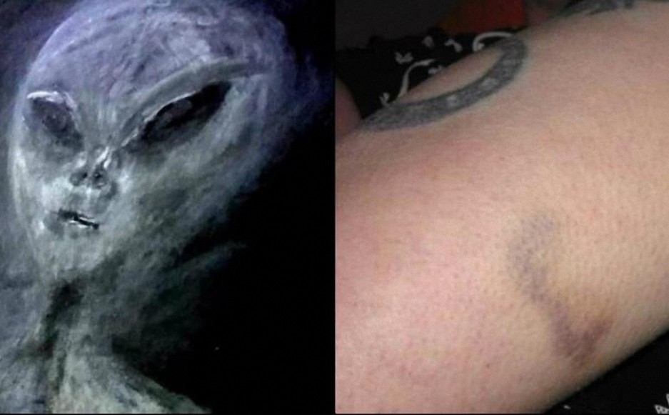 Implantes extraterrestres: ¿Prueba definitiva de las abducciones?