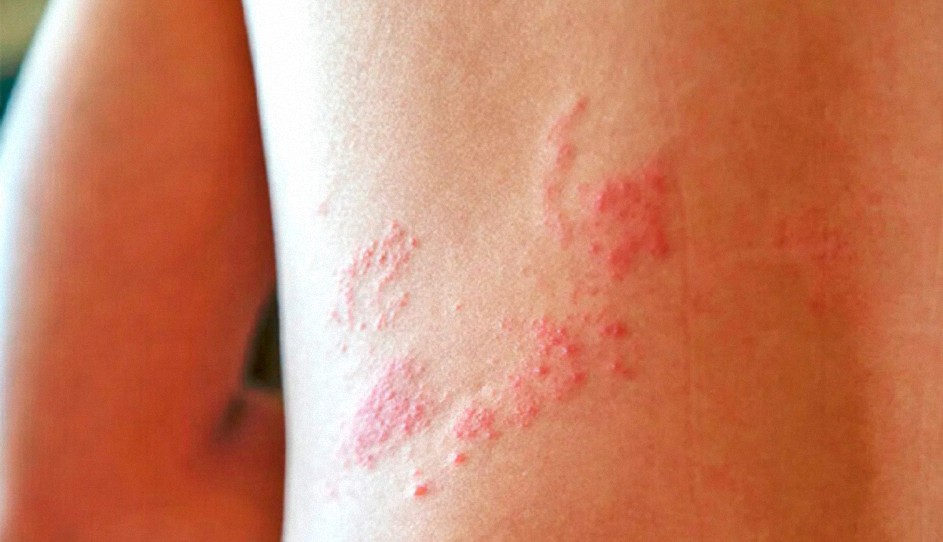 Pretenden disimular el aumento de culebrilla, Herpes Zoster, causado por la inyección Covid